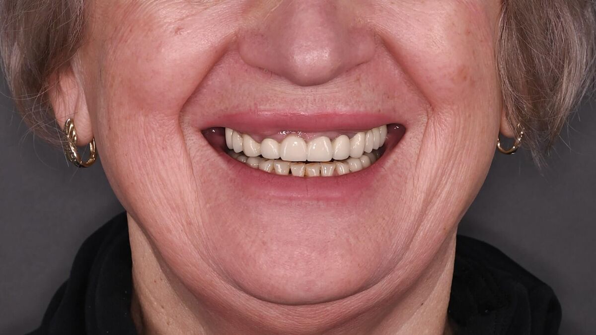 Zâmbet lateral stanga_înainte